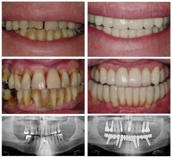 How To Get Rid Of Gaps In Teeth: Gap Filling Options