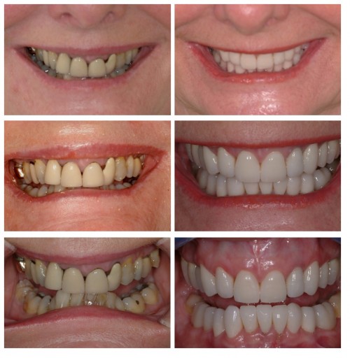 Surprising Causes of Chipped Teeth - New York Dental Office New York New  York