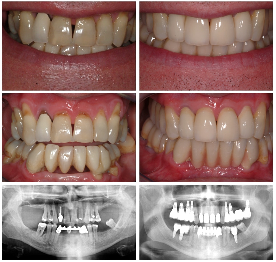 Dental bridge work - before and after including x-rays