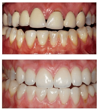 Aesthetic Dentistry - before and after