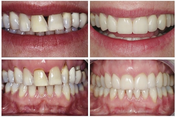 Porcelain veneers before and after