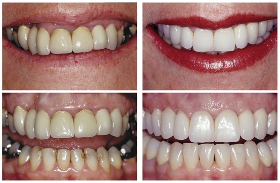 Tooth crowns before and after