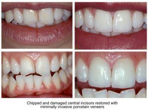 Chipped teeth - damaged central incisor repairs