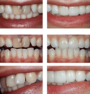 Porcelain veneers before and after