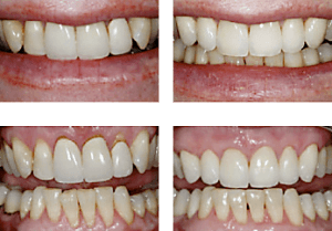 Tooth crowns before and after