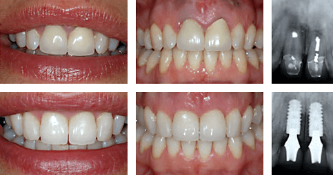 Dental work before and after