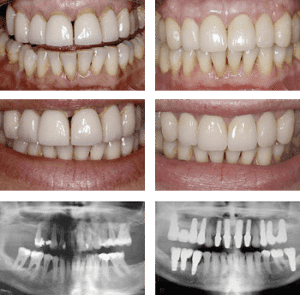 Dental implants example