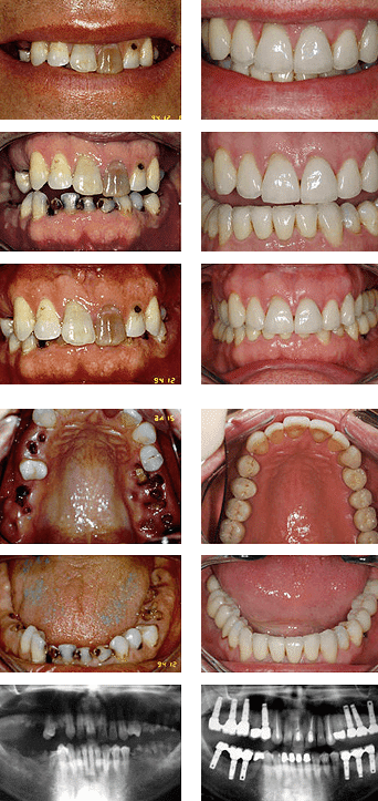 Full mouth rehabilitation - before and after