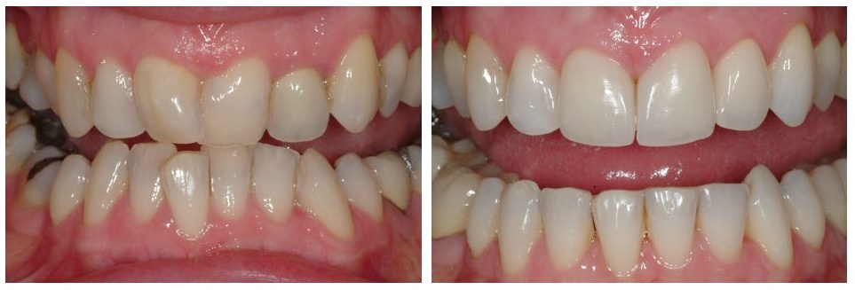 Orthodontic work before and after