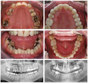Orthodontic work before and after with x-ray