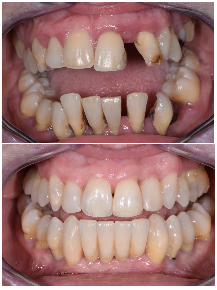 Periodontal Disease Treatment