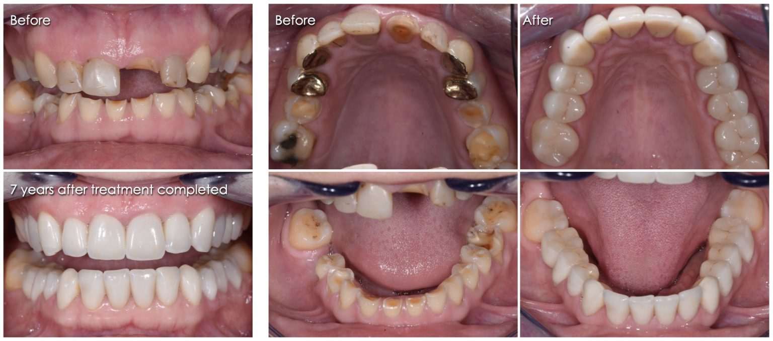 Worn Teeth | How to Treat Worn Down Teeth
